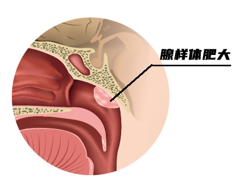 腺样体肥大.jpg 腺样体肥大.jpg